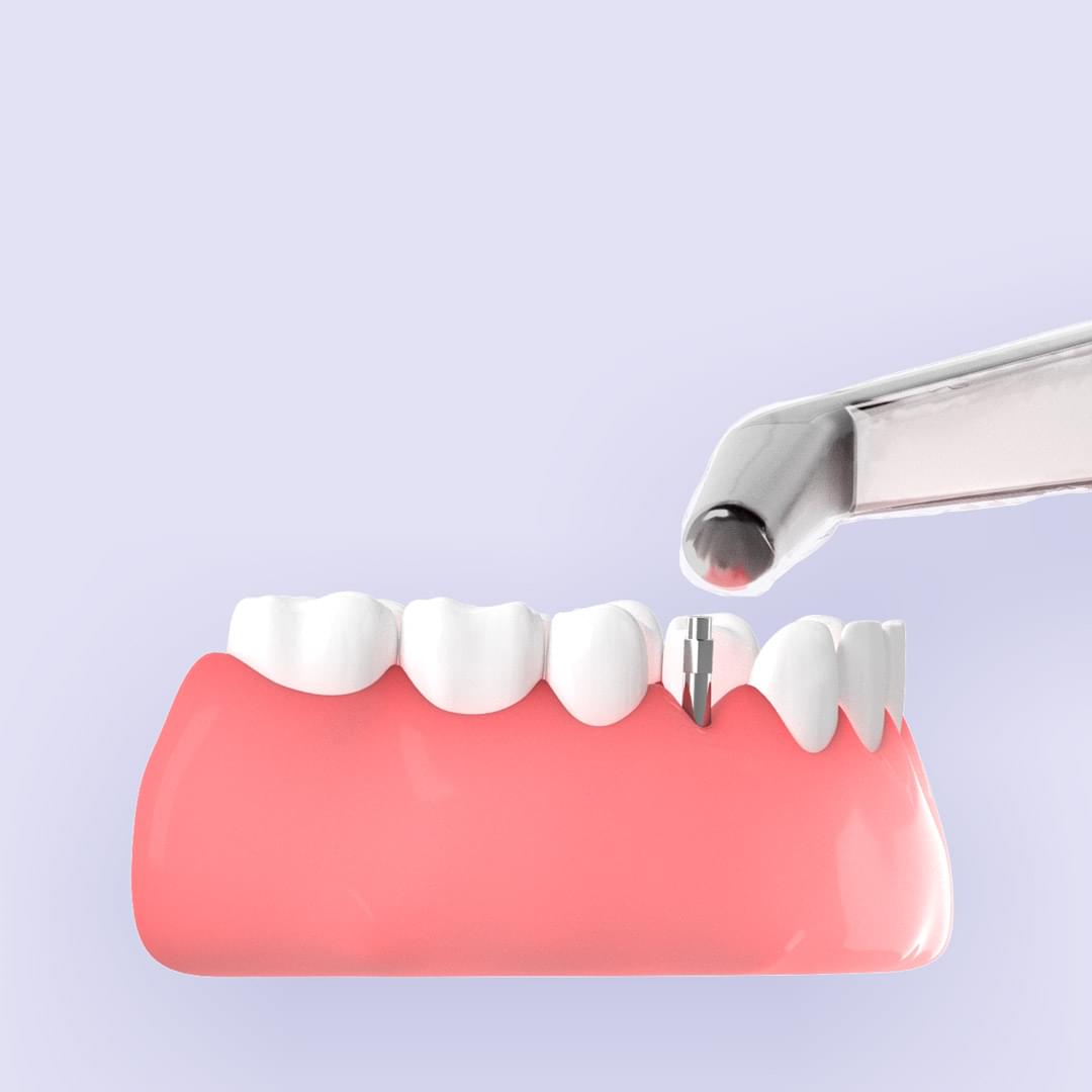 Visualization of teeth where a tooth is replaced with an implant where Ostell's instrument measures stability in the implant.